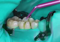 Composite restoration 2 Composite restoration 2