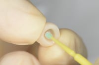 Indirect resin 1 Indirect resin 1