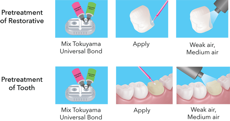 Pretreatment of Restorative and Tooth